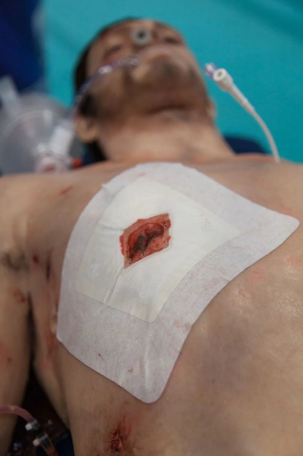 Russell Chest Seal